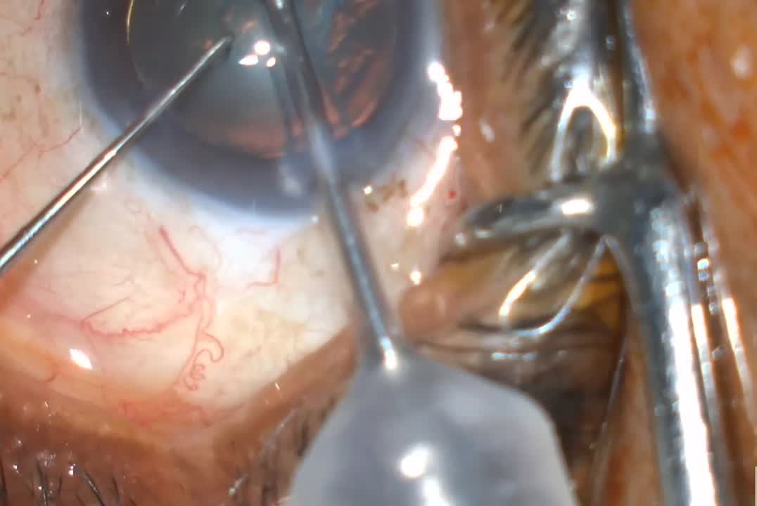 Hard Cataract Removal With the Qube Pro Phacoemulsification System (Case 2)