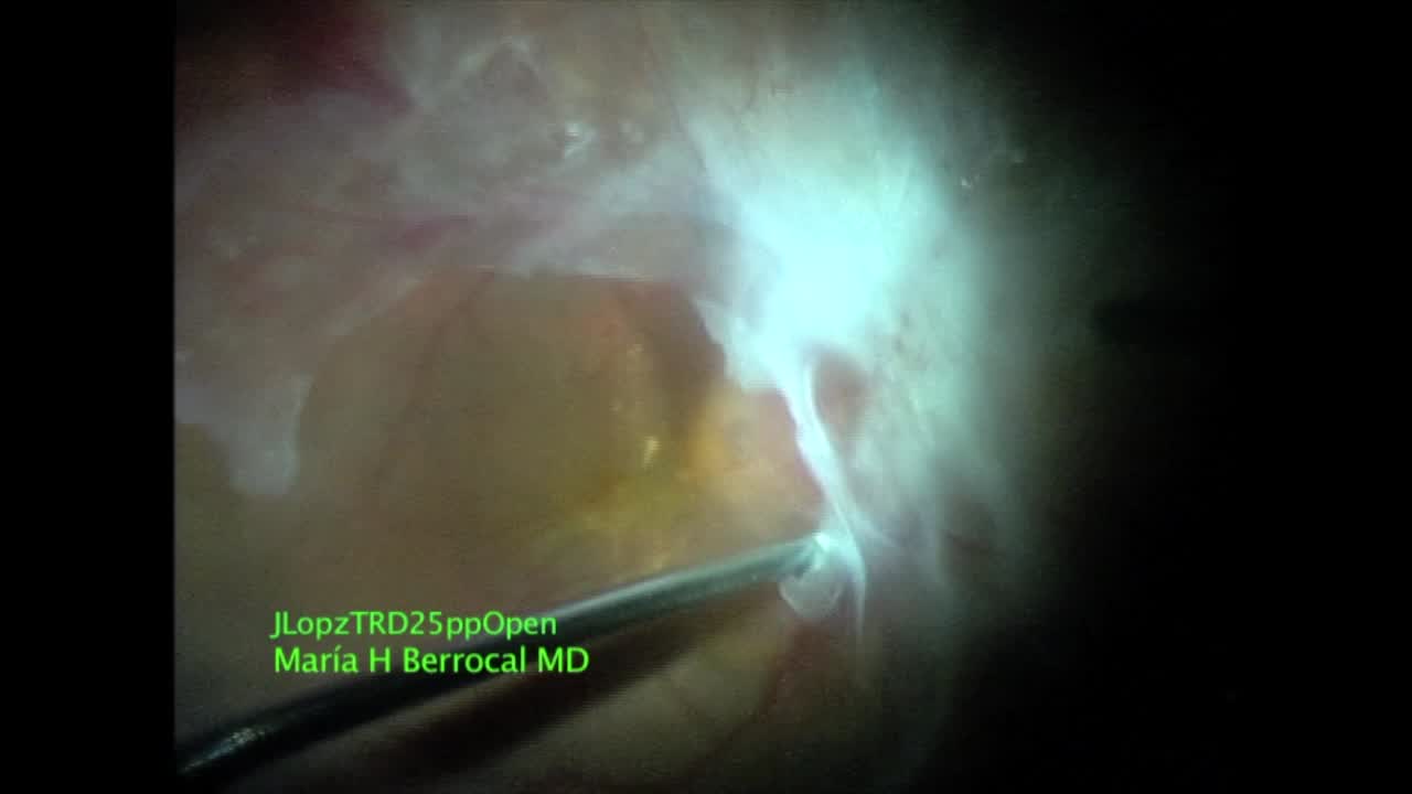  Inside Out Vitrectomy Technique