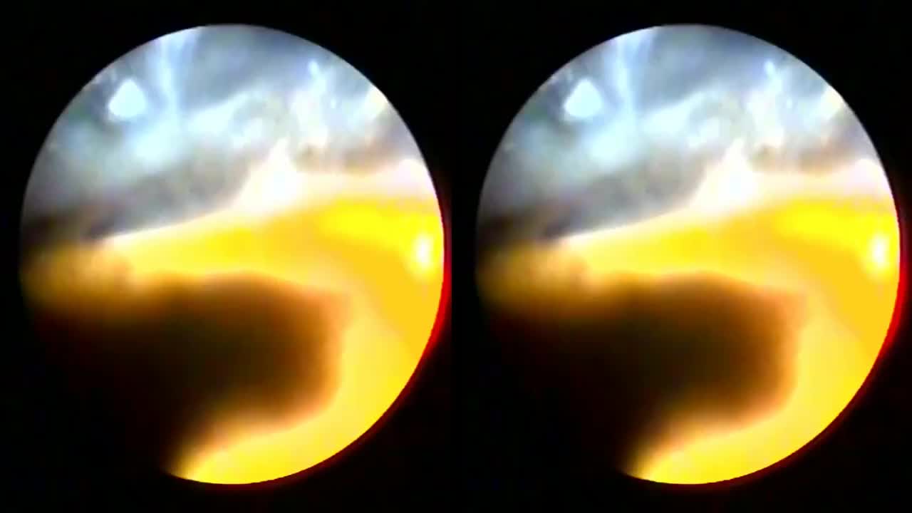 3D Endoscopic Glaucoma Procedure