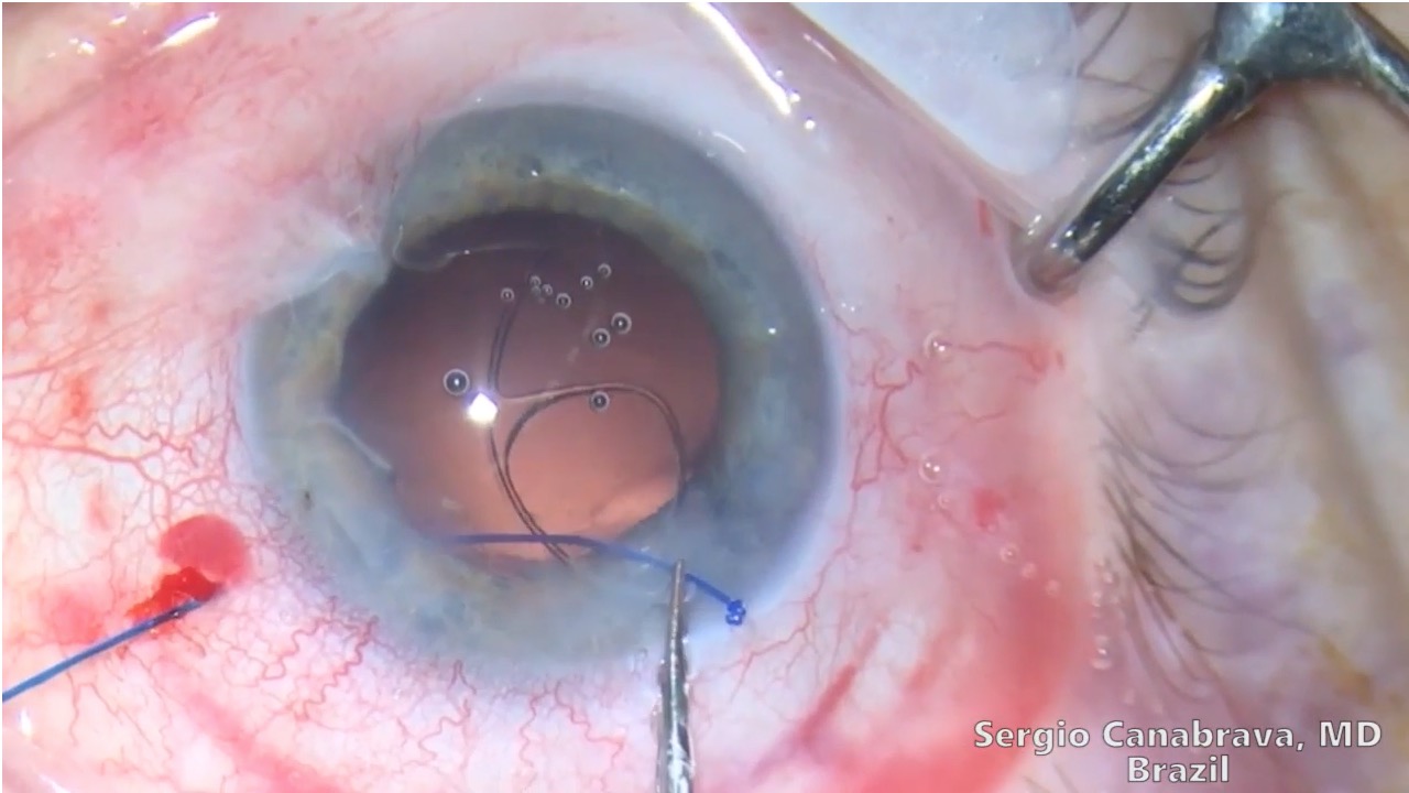 New Management for Subluxated Cataract: Double Flanged for CTS
