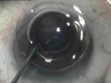 Cataract Surgery with an Accommodative IOL