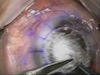 Scissors Dissection for Deep Anterior Lamellar Keratoplasty