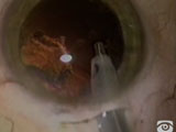 Zonular Dialysis