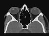 Metallic Foreign Body Embedded in the Posterior Lens Capsule