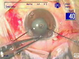 Coloboma