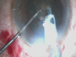 Long Oval Capsulotomy in Hard Cataract