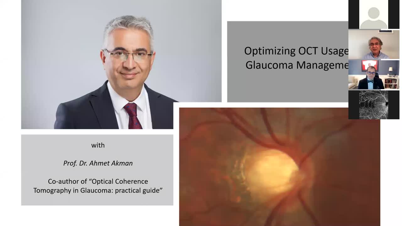Optimizing OCT usage in Glaucoma Management