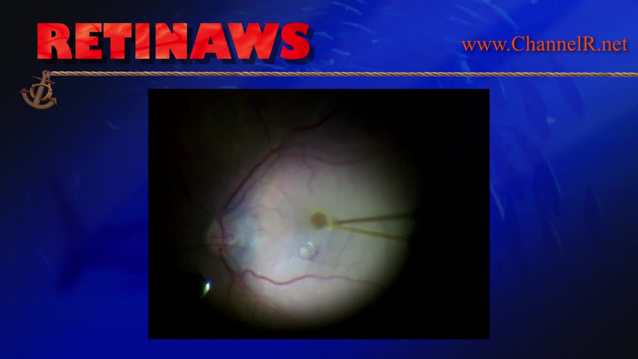 Subretinal Perfluoron - Eyetube