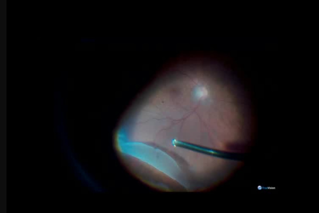 Giant Retinal Tear