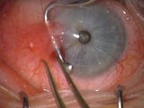 Cut and Paste Method for Pterygium Autograft Surgery