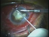 Ultrasound-Assisted Pars Plana Vitrectomy