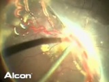 Tying Off von Hippel Angionoma