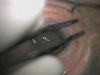 Multi-Purpose Extraocular Forceps for Small Gauge Pars Plana Vitrectomy
