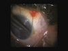 Subconjunctival Loiasis