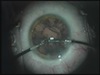 Posterior Polar Cataract