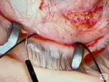 Insertion of Morcher ring with Geuder Capsular Tension Ring Injector