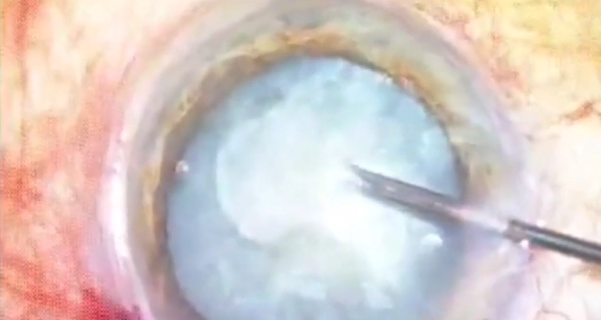 Capsular Fibrosis