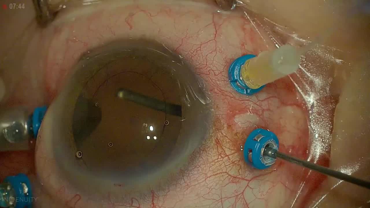 Thick Choroid