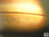 Corneal Wedge Technique in PDS