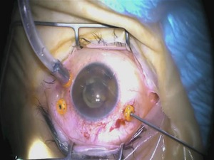 Severe Diabetic Tractional Retinal Detachment With Recurrent Vitreous Hemorrhage