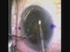 Flip and Slice Technique for Cataract Surgery