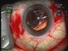 Fixation of an in-the-bag of Dislocated IOL