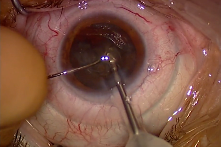 Cataract Surgery in a High-Volume Clinic