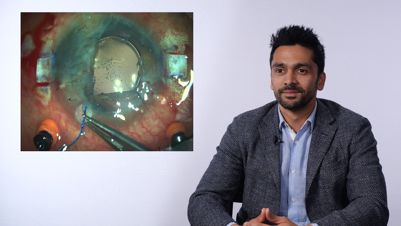 Iridodialysis and Intrascleral Haptic Fixation