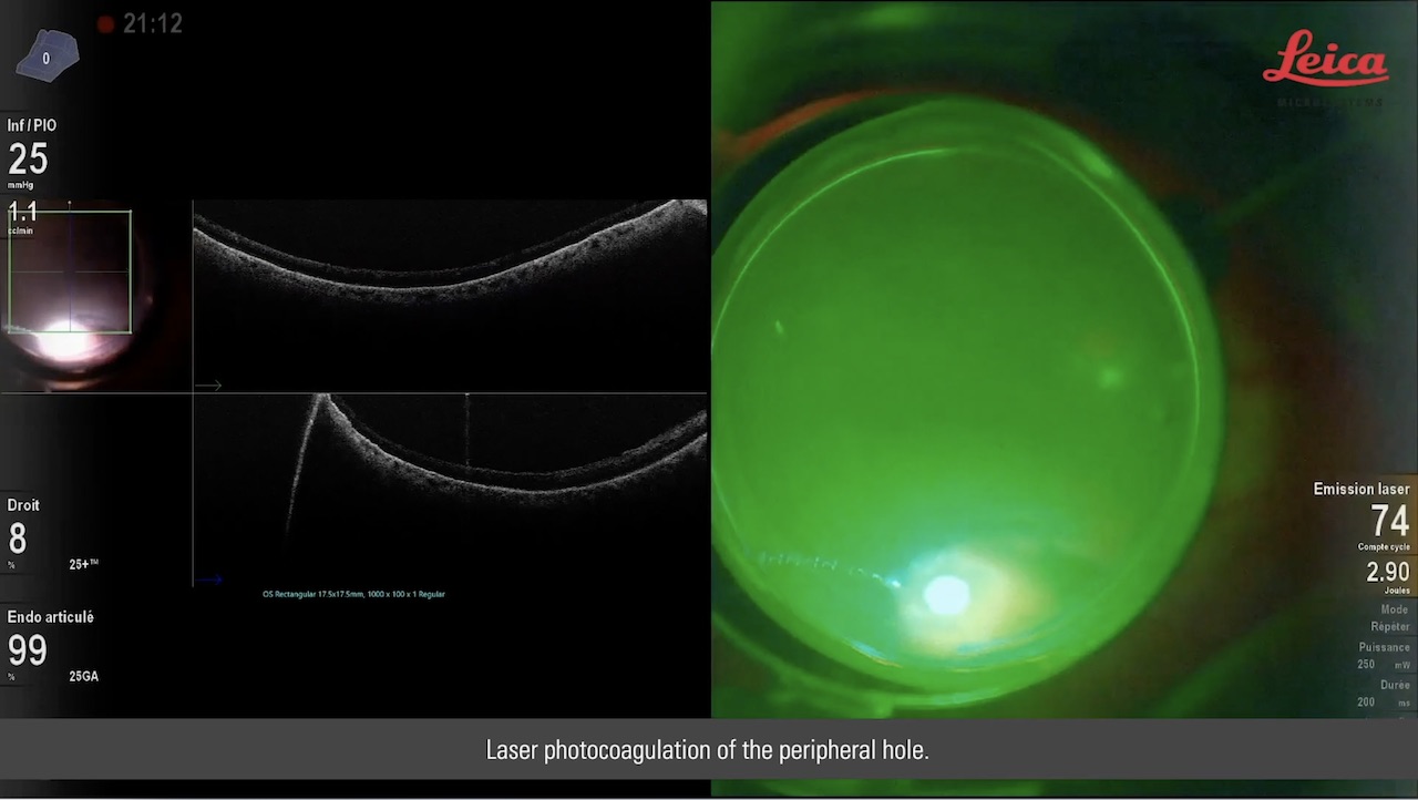 25G Vitrectomy and Epiretinal Membrane Peeling with the Proveo 8 and EnFocus Intraoperative OCT (Imaged with Ngenuity)