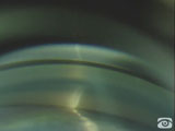 Corneal Wedge in Narrow Angle