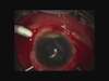 IOFB on the Retina