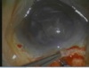 Capsular Block Syndrome