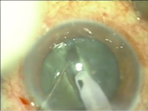 Phacoemulsification in Vitrectomised Eyes