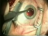 Safety Suture for CTR