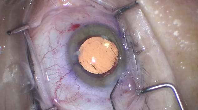 Dexycu Intracapsular and Ciliary Sulcus Techniques Plus Pearls