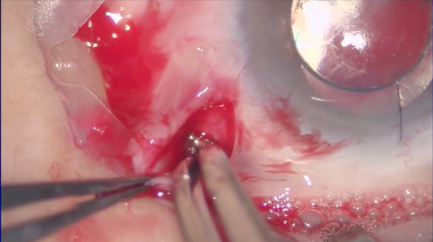 Sclerotomy Hemorrhage