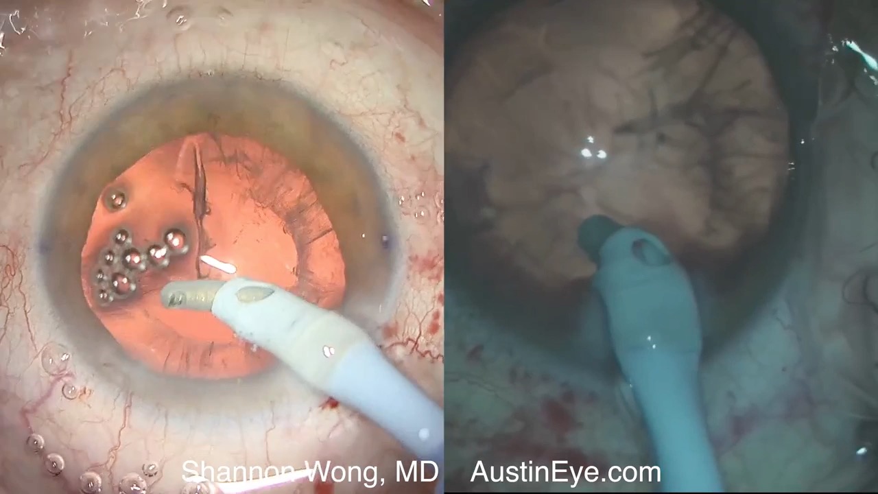 Cataract Surgery 4K vs 1080p Video Review