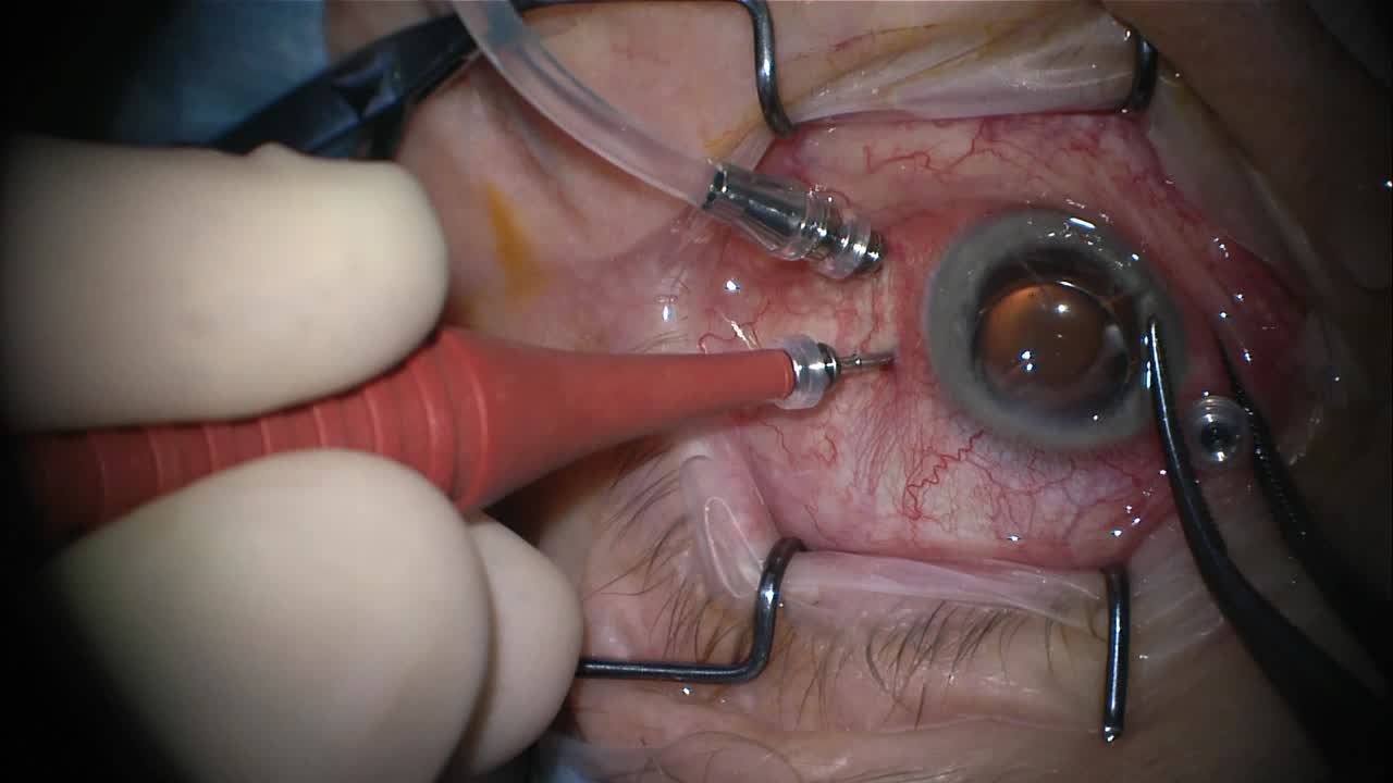 FCI RetiLock Trocar/Cannula System