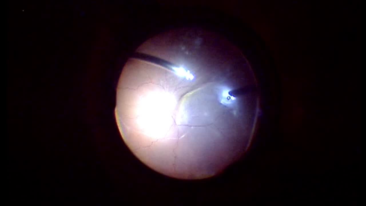 Bilateral Retinal Detachment