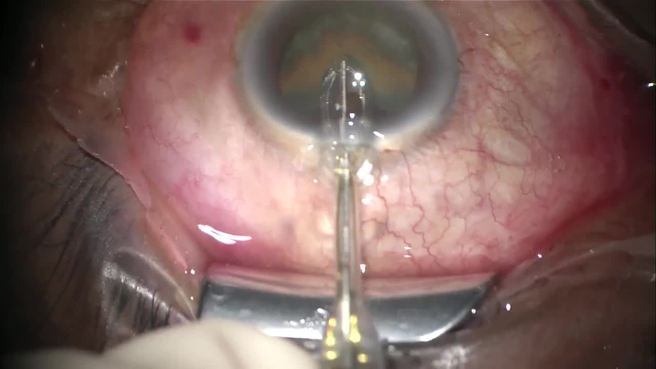 ZEPTO Assisted Cataract Surgery