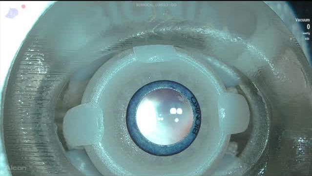 Bioniko Eye Model In Vitreoretinal Surgery