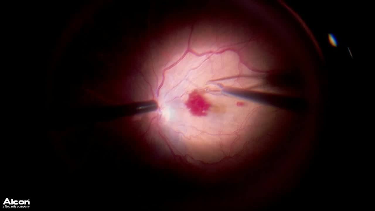 Peribulbar Hemorrhage