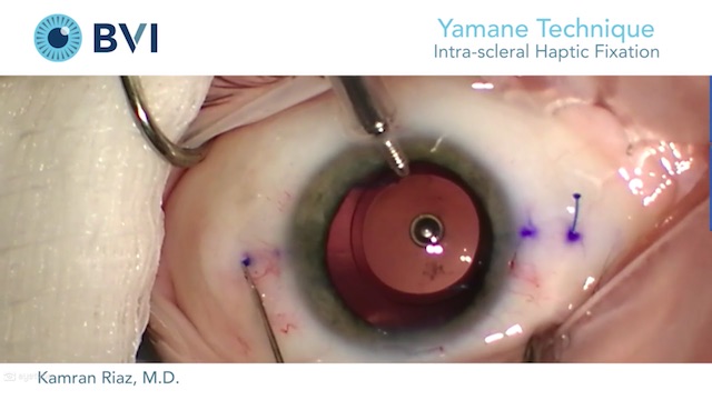Yamane Technique