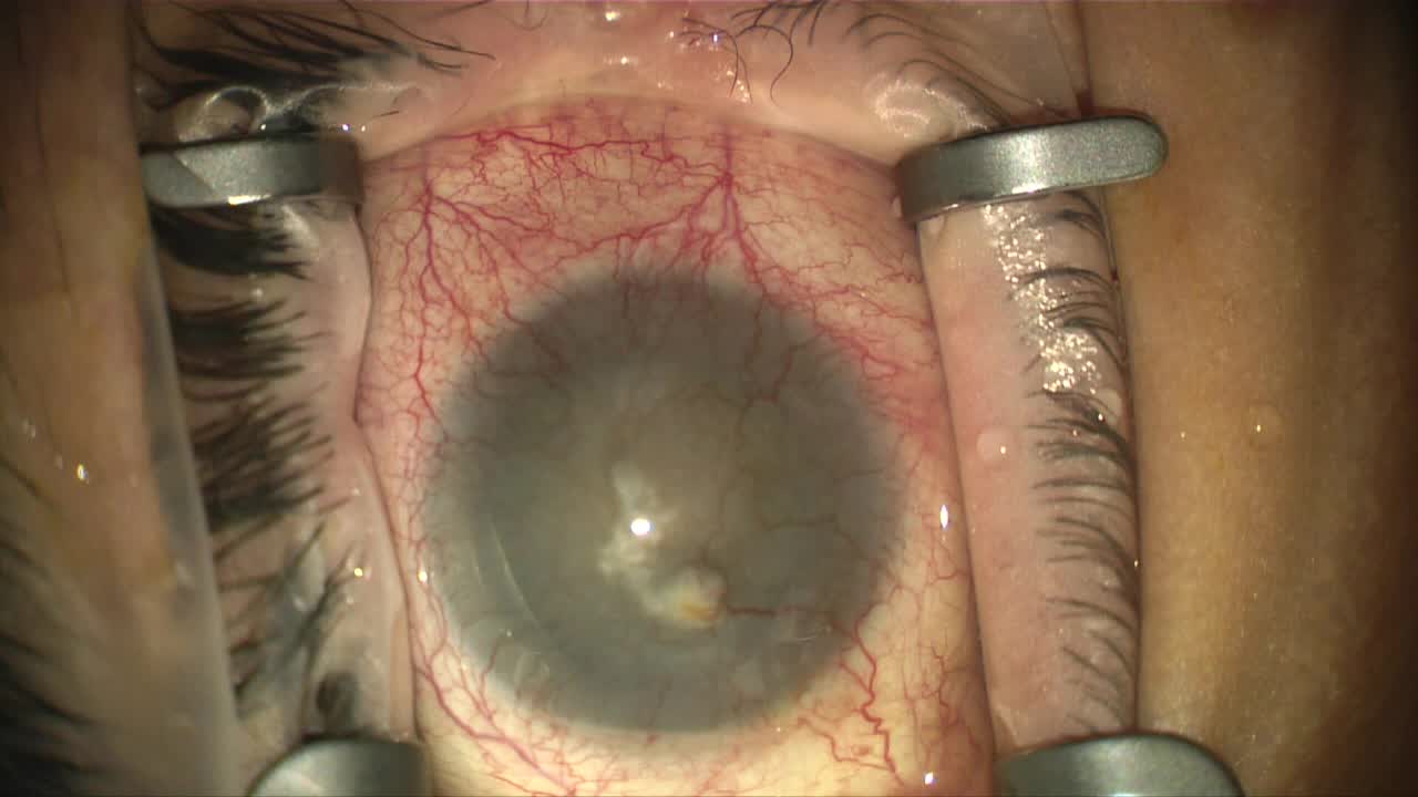 Cataract Surgery Through a Clouded View