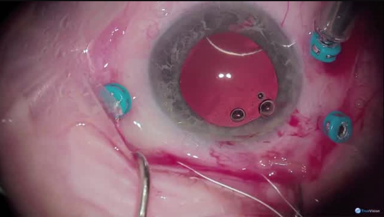 25g PPV with IOL Exchange and Sutured CZ70BD Lens: A New Technique