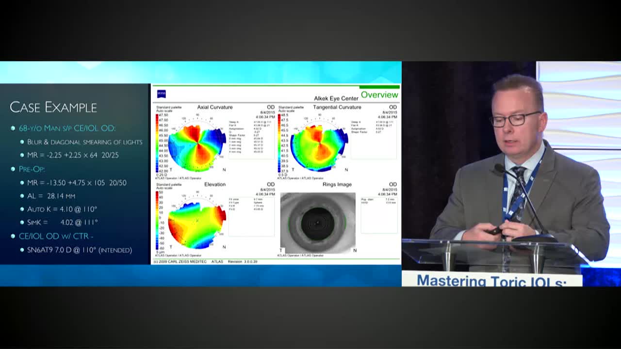 Residual Astigmatism After Toric IOL Implantation