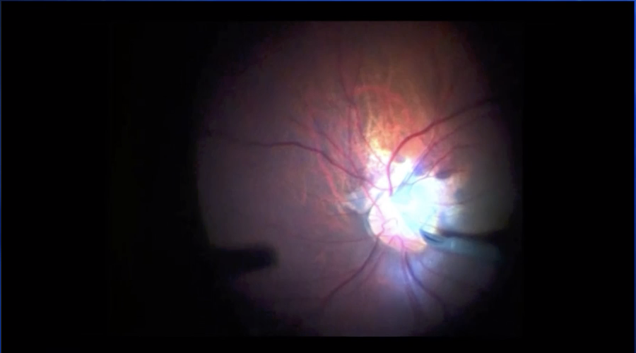 Optic Nerve Pit