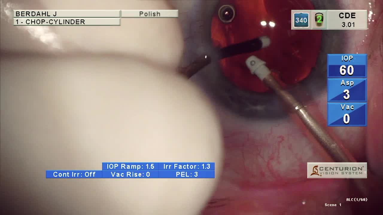 Intrepid Transformer Irrigation and Aspiration Surgical Video