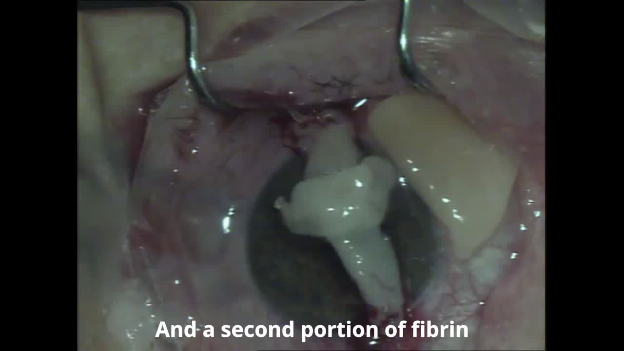 PUK and Endoret Fibrin Implant