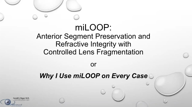 miLoop: Anterior Segment Preservation and Refractive Integrity With Controlled Lens Fragmentation